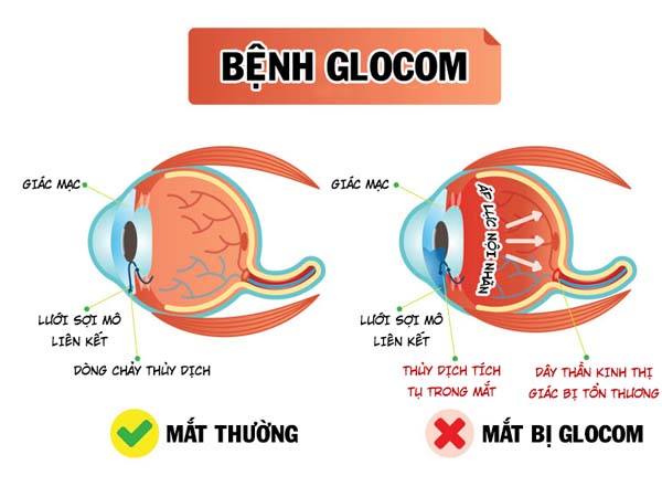 Triệu chứng sớm dễ nhận biết của bệnh Glôcôm